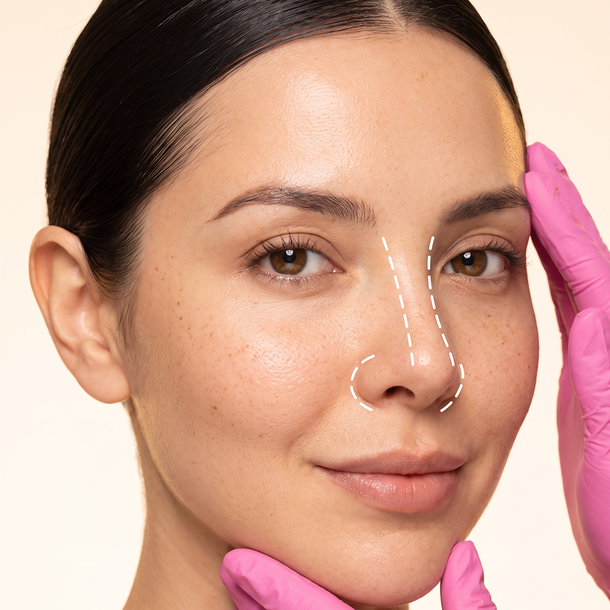 Septorrinoplastia Estética y Funcional